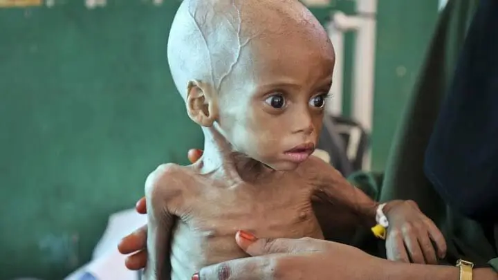 Malnutrition Nightmare Near Mumbai 163 Affected, 9 Critical